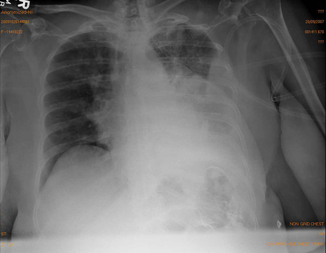 Chest X-Ray